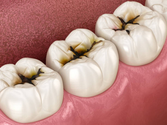 What is dental pulpitis?